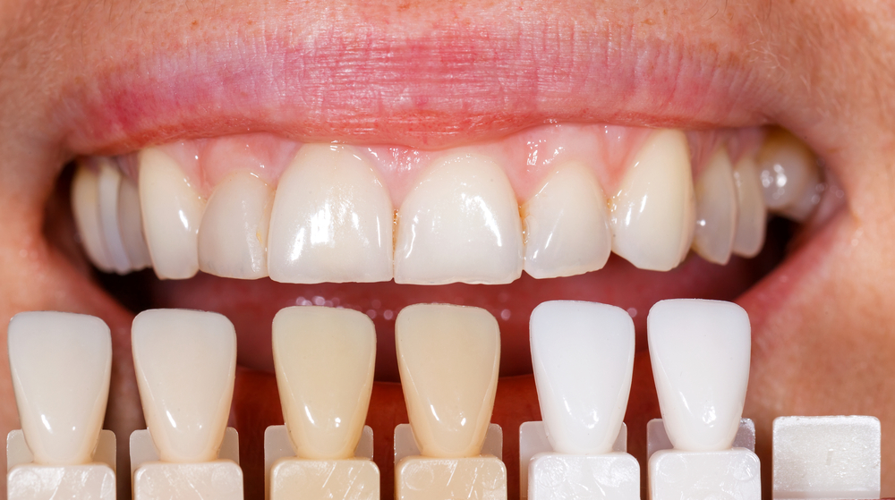 Understanding Veneers Cost | Guide to a Beautiful Smile Investment